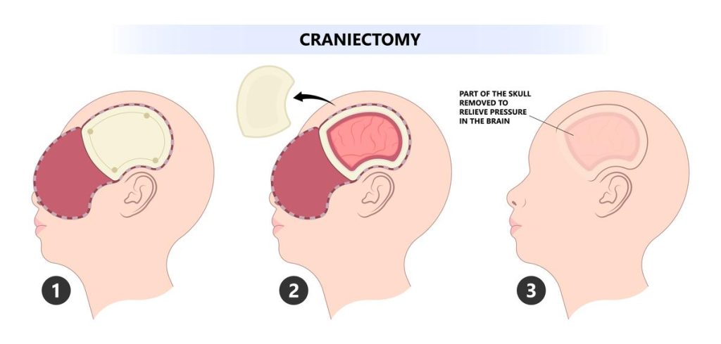 What is a craniectomy?