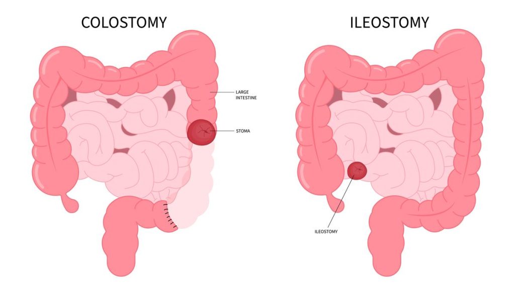 Colectomy Surgery (Bowel Resection)