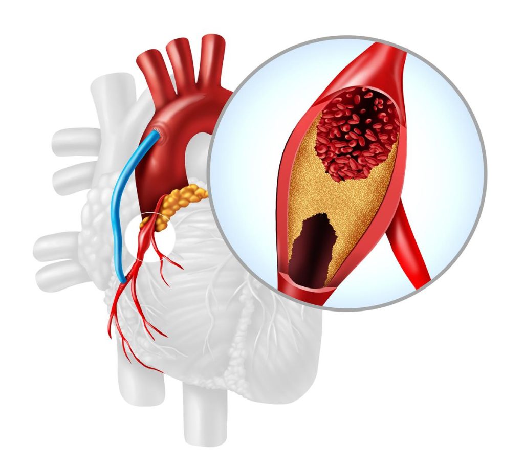 Coronary Artery Bypass Surgery