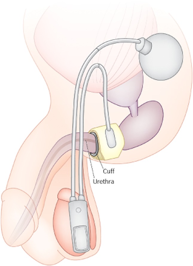 Neurogenic Bladder