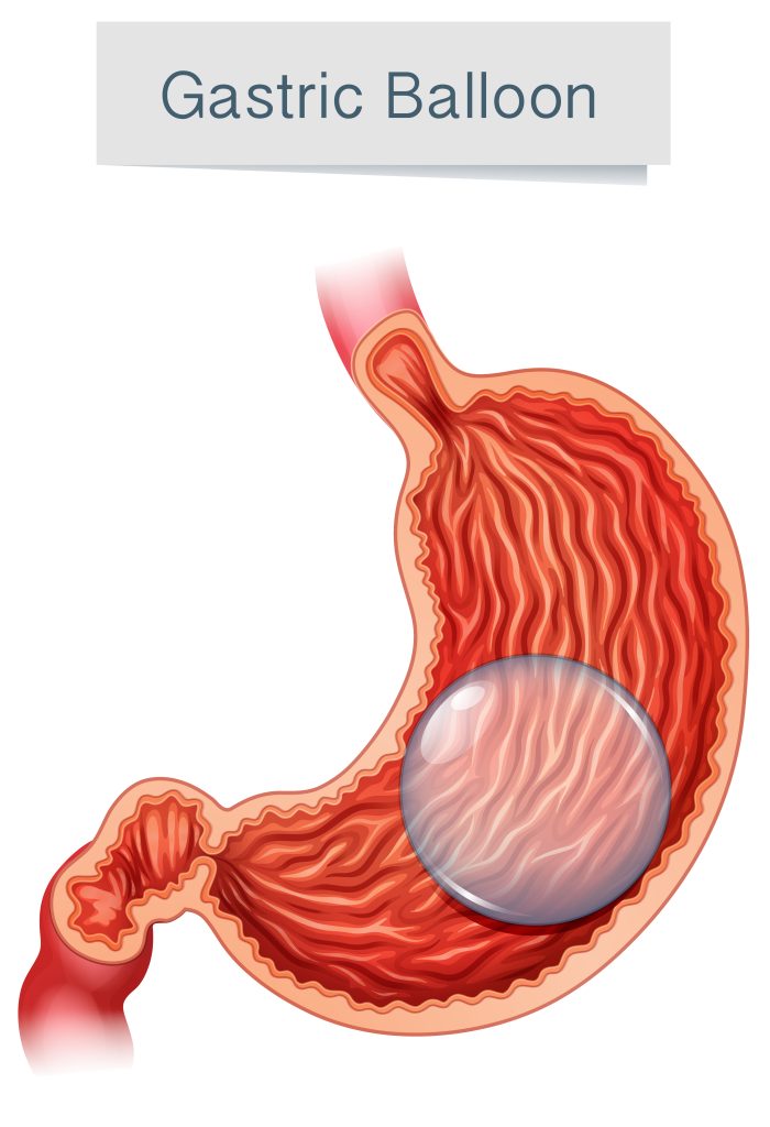 Intragastric Balloon