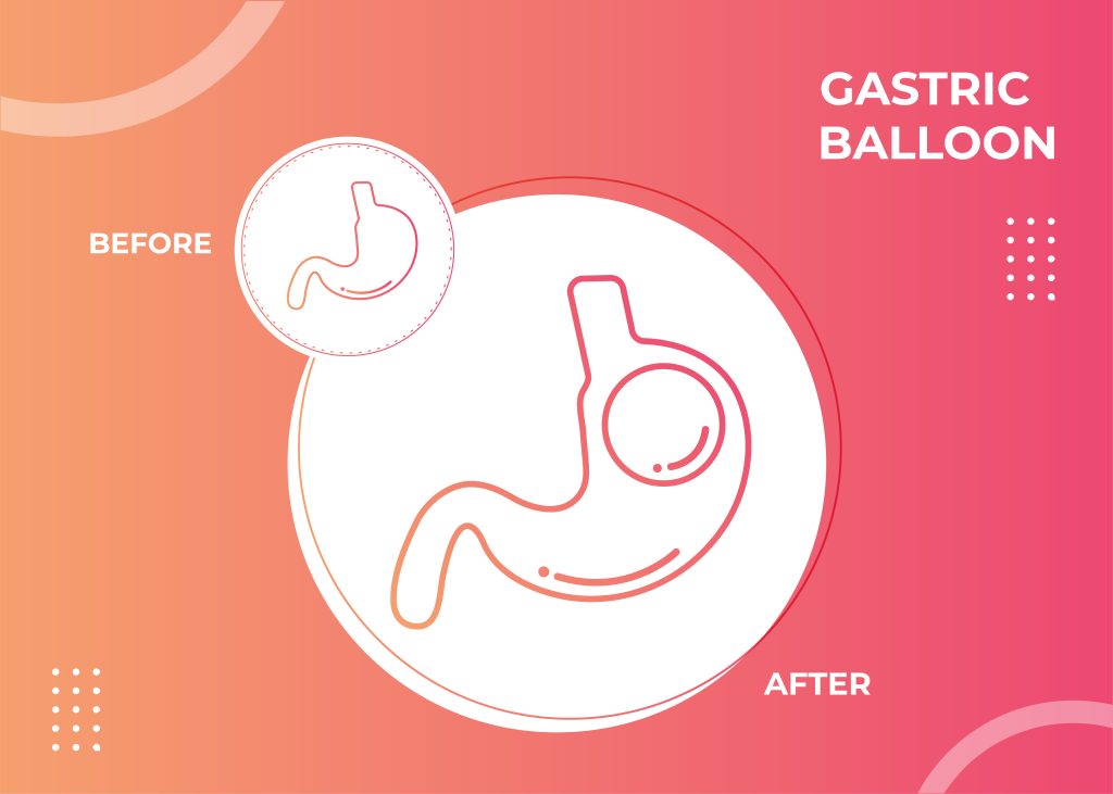 Intragastric Balloon