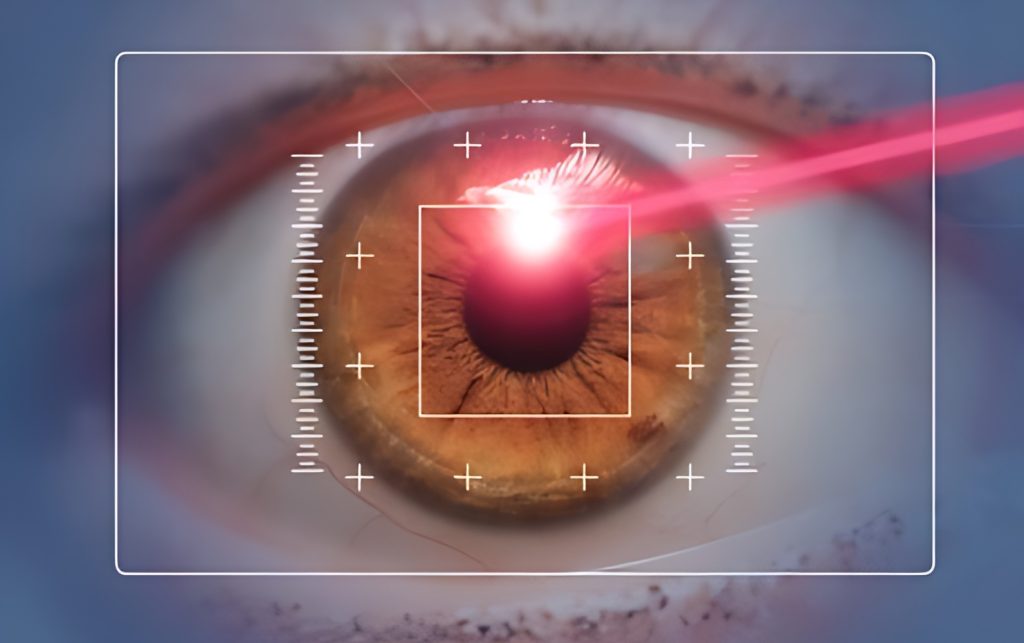 Refractive lens replacement in Türkiye