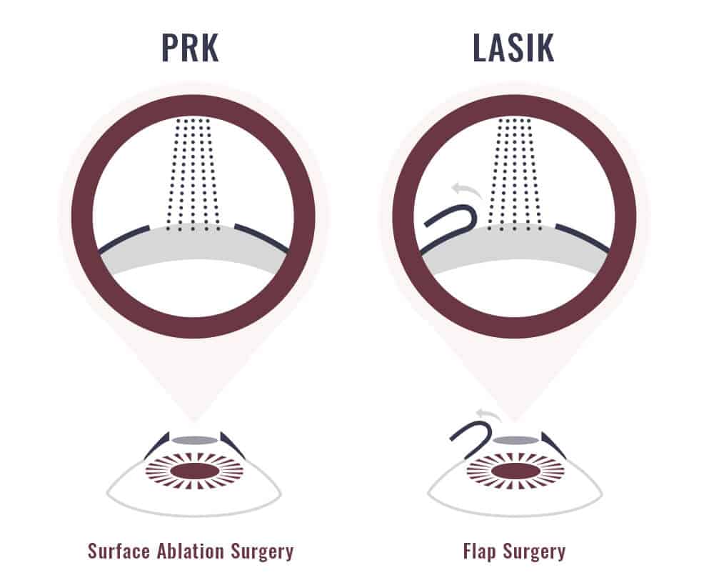 Photorefractive Keratectomy (PRK) Eye Surgery