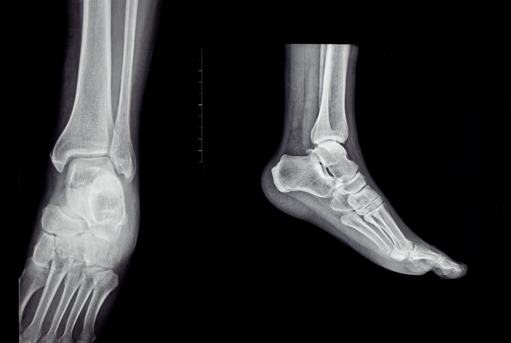 What is ankle replacement surgery?