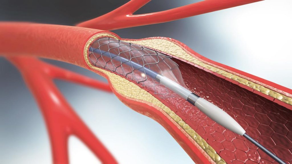 BALLOON VALVULOPLASTY