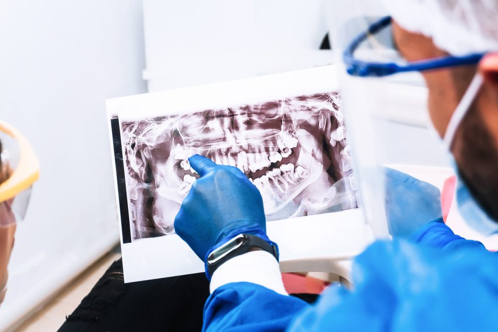 Dental Bone Graft