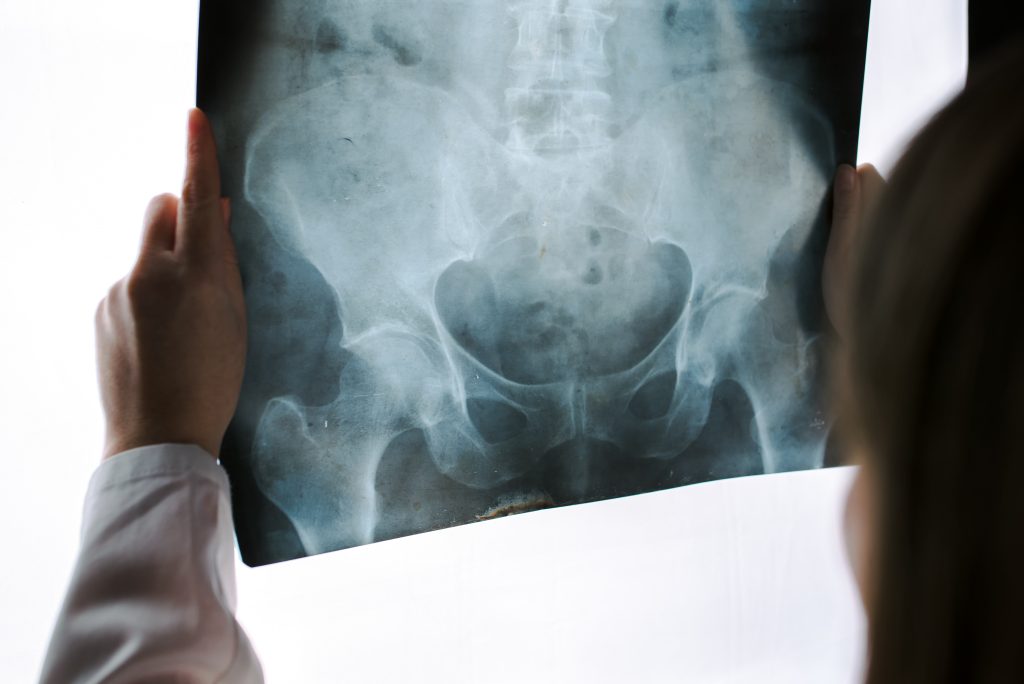 Hip Arthroscopy