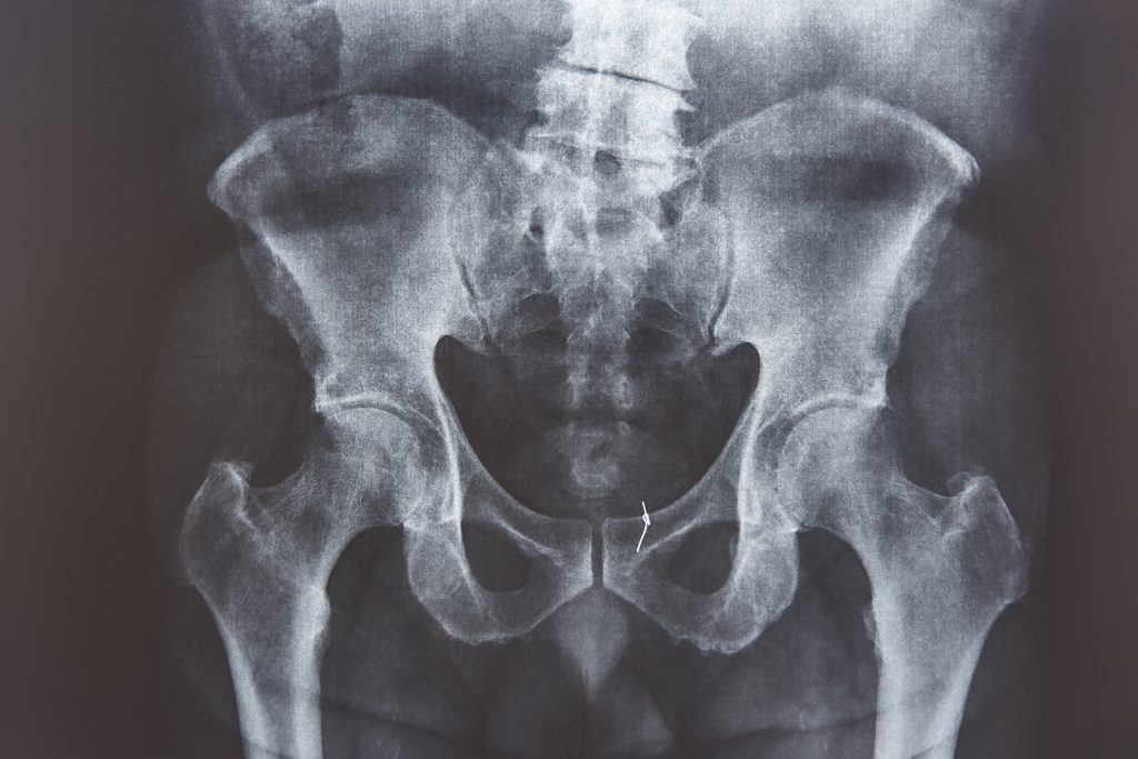 Hip Arthroscopy
