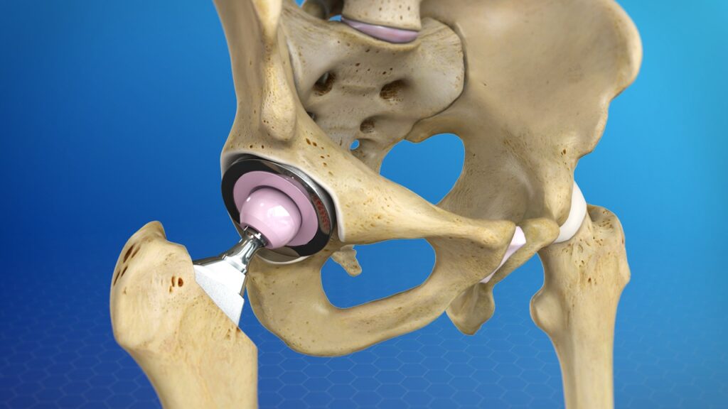 Hip Revision Surgery