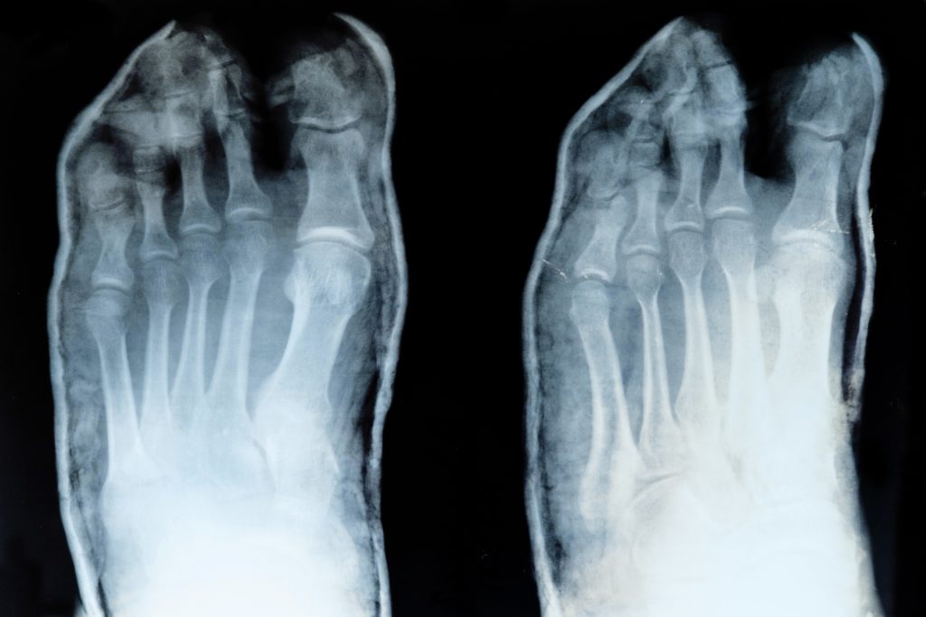 Toe Joint Replacement