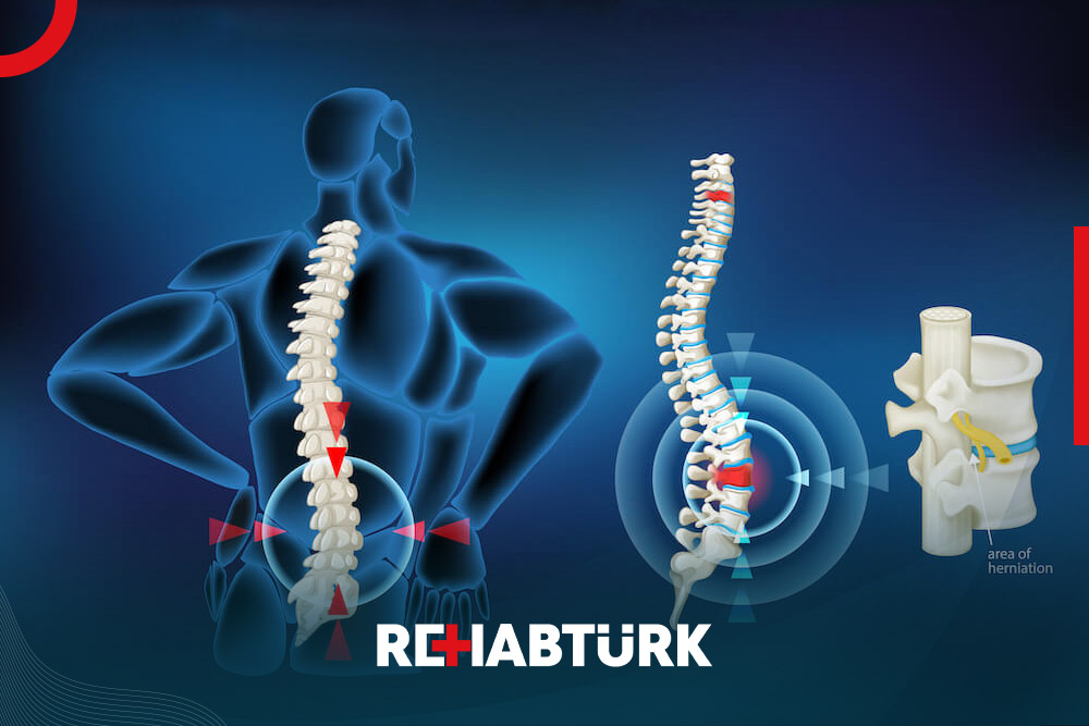 Spinal Disc Excision Surgery in Türkiye
