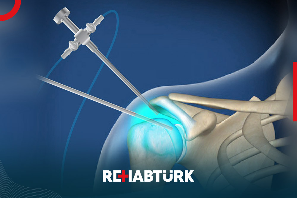 Shoulder arthroscopy in Türkiye