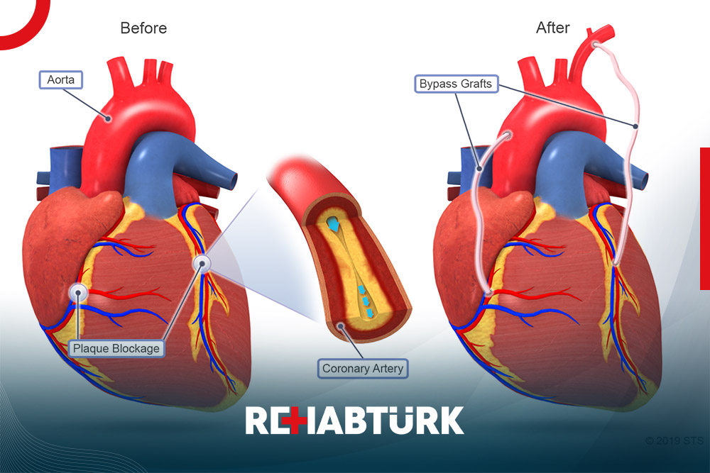 Coronary artery bypass surgery in Türkiye