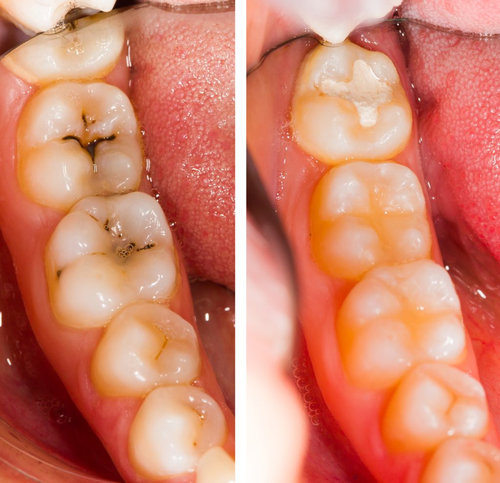 What are Dental Fillings?