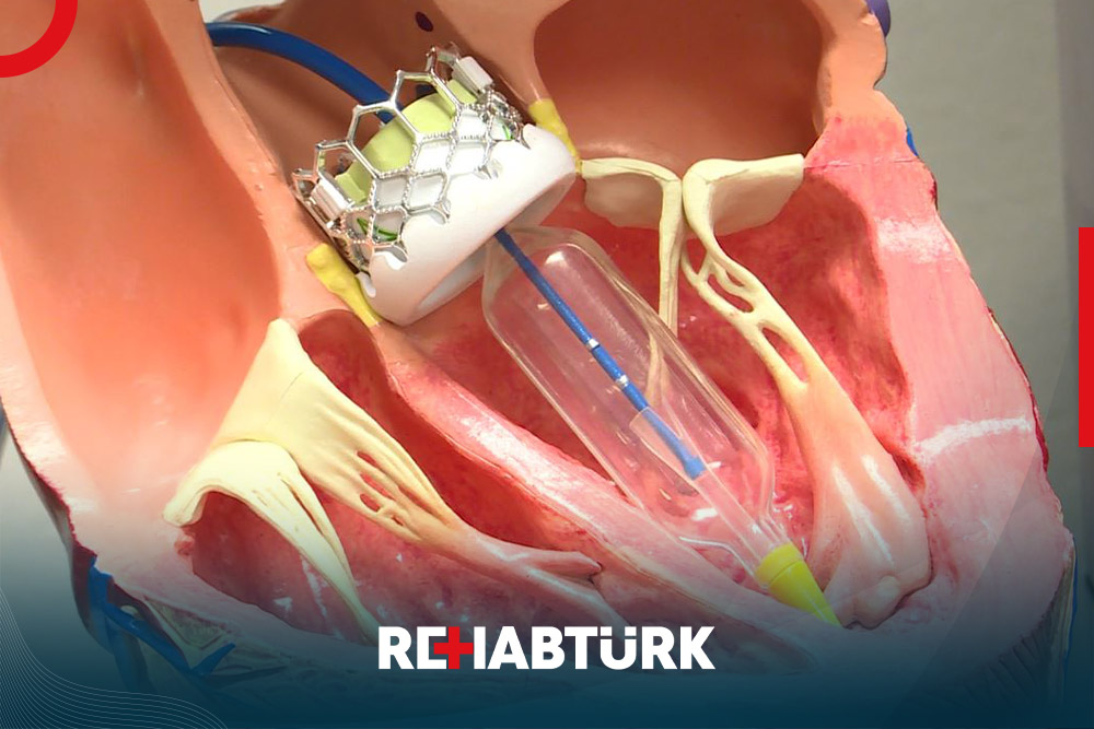 Heart valve replacement surgery in Türkiye