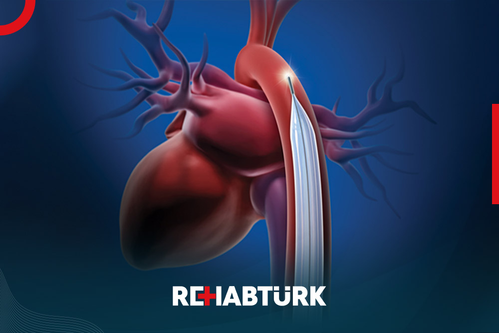Intra-aortic balloon pump in Türkiye