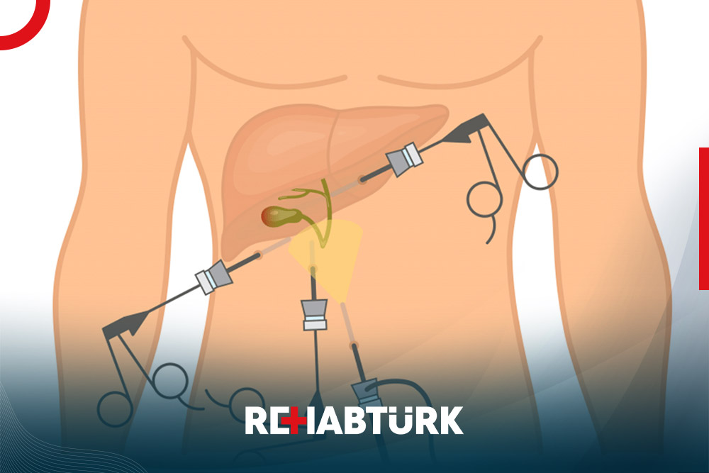 Laparoscopic cholecystectomy in Türkiye