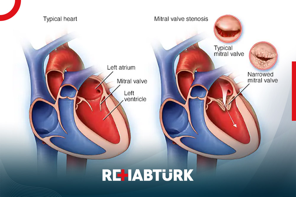 Mitral valve stenosis treatment in Türkiye