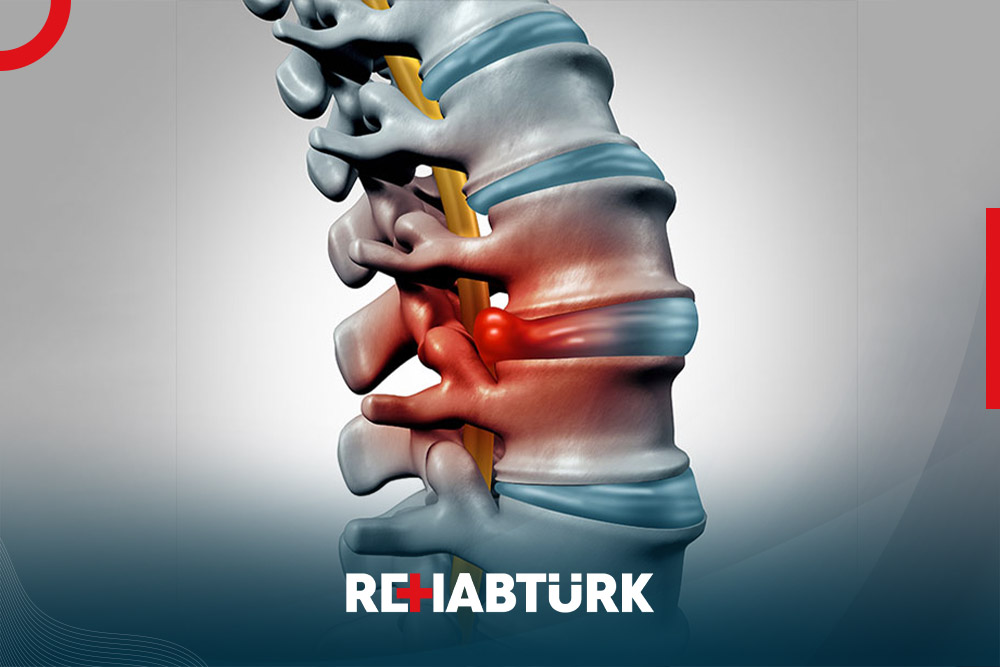 Spinal Stenosis Surgery in Türkiye