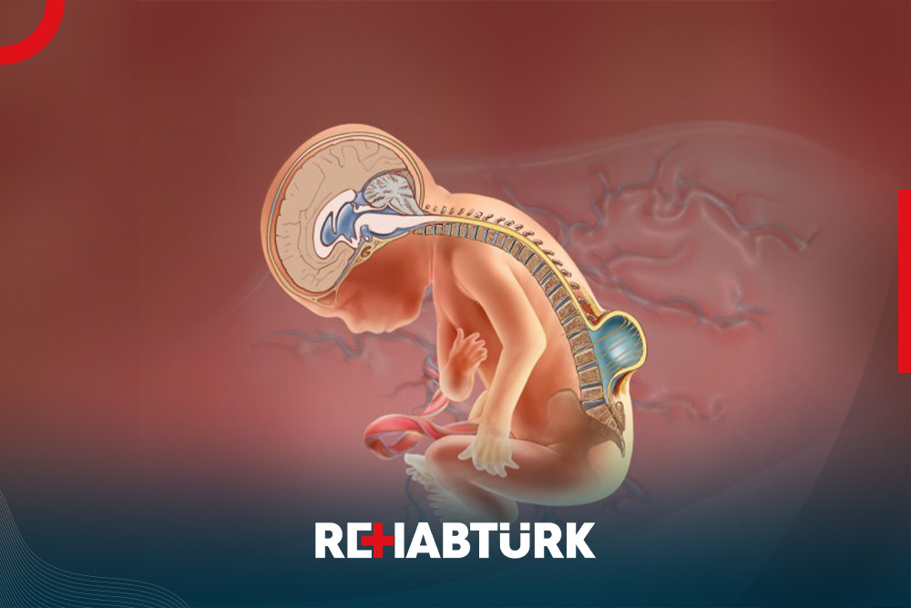 Treatment of Spina Bifida in Türkiye