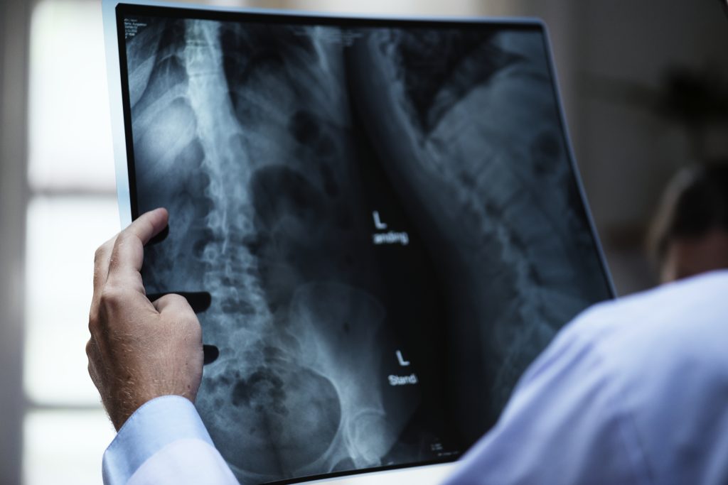 Spondylolisthesis: Symptoms, Diagnosis, Types