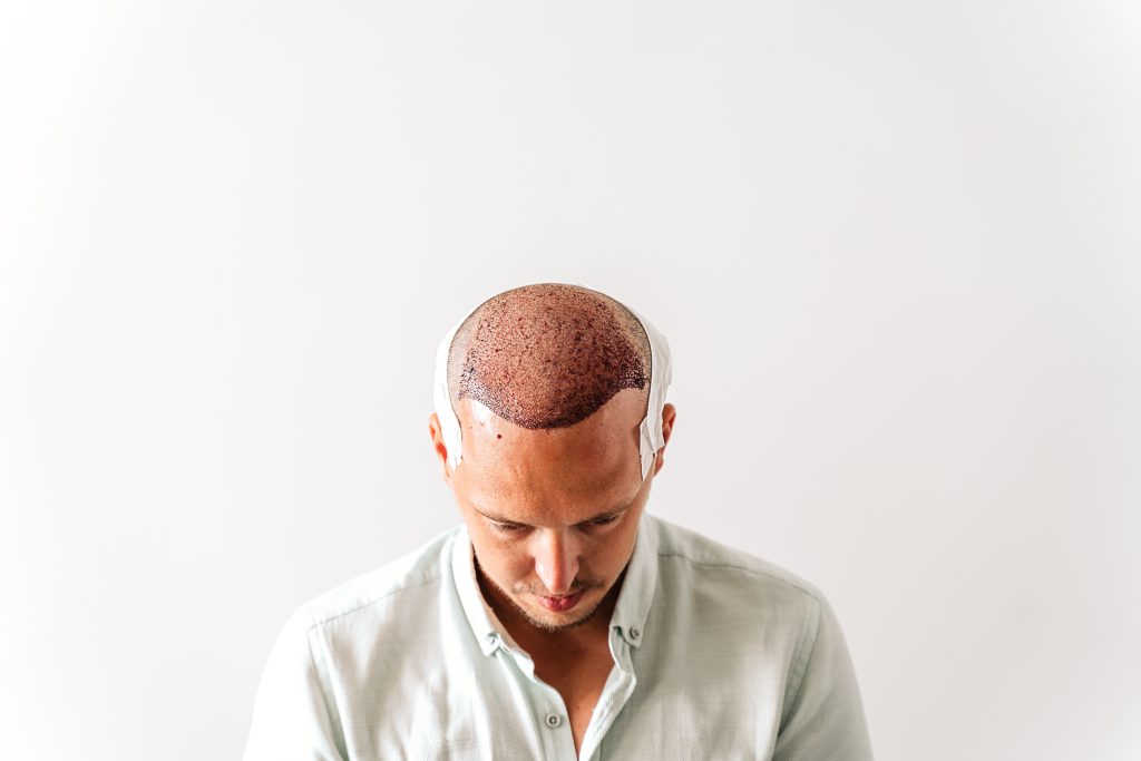 What is a FUE hair transplant?