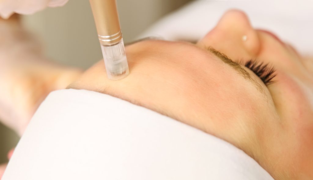 What is microneedling with PRP?