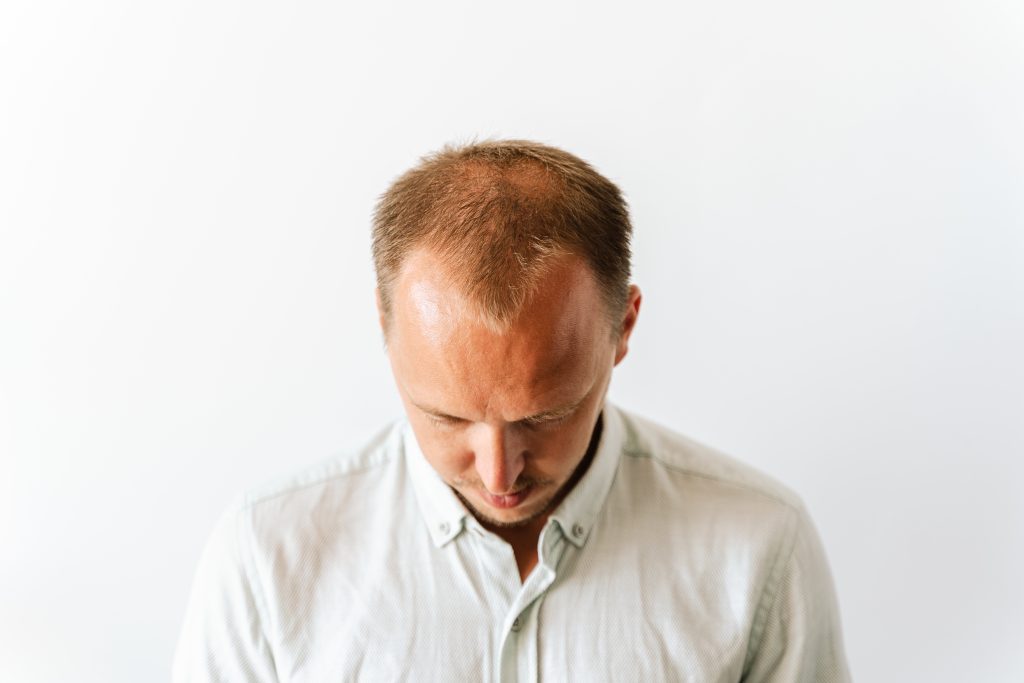 What is a FUE hair transplant?