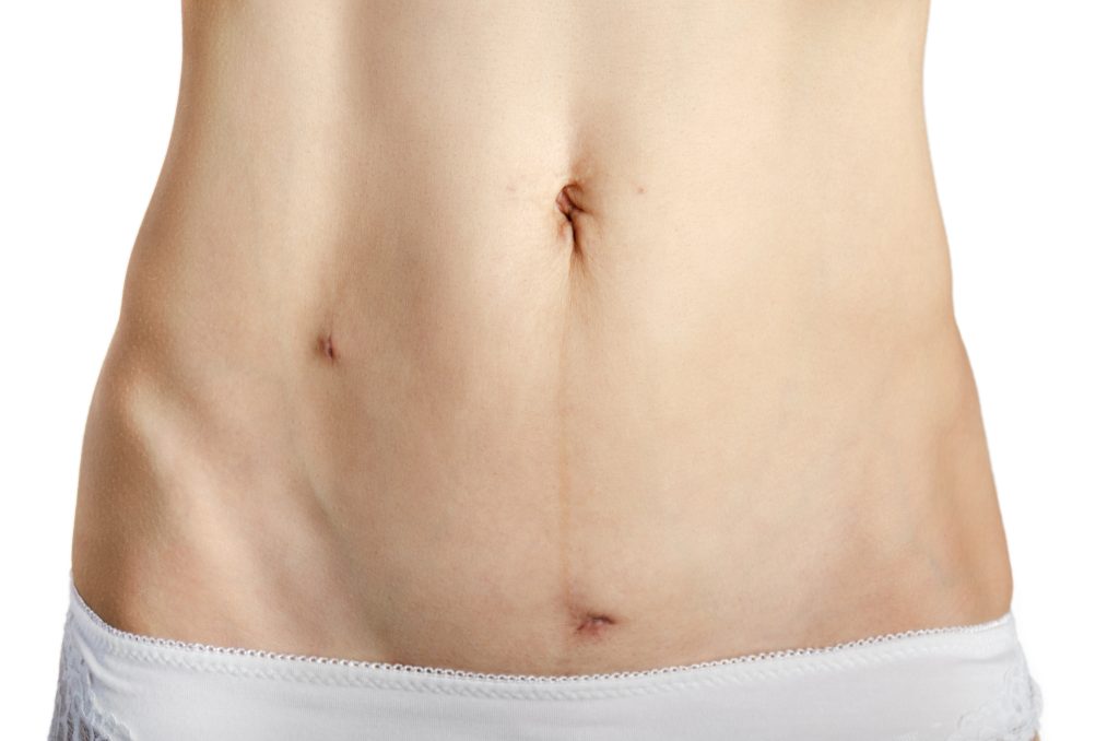 What is a laparoscopic cholecystectomy?