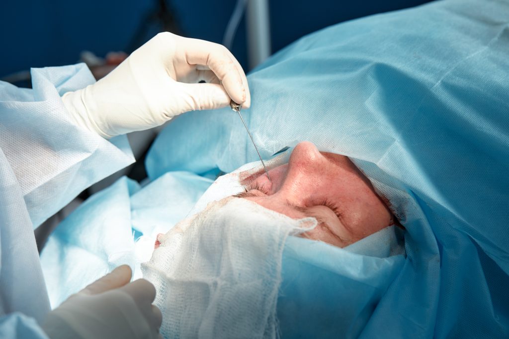 What is Double Eyelid surgery?