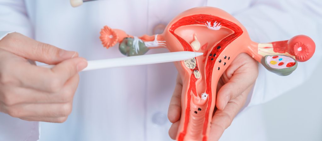 Hysterectomy in Türkiye
