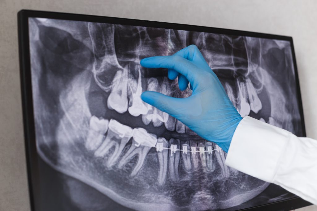 What are Dental Fillings?