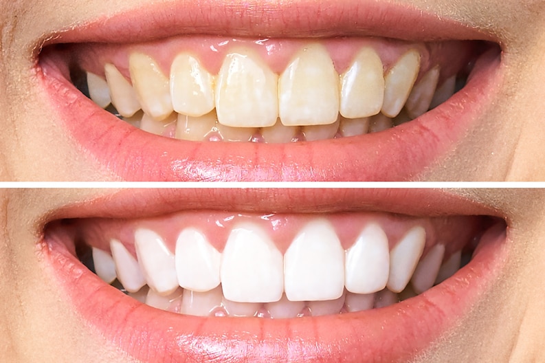 Gum Contouring