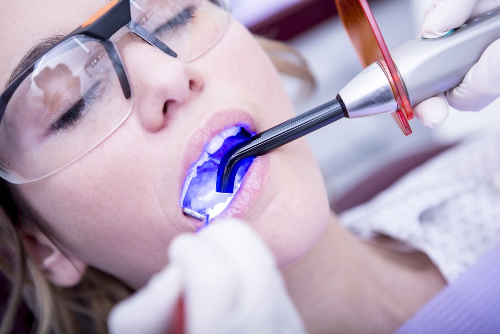 What are Dental Fillings?