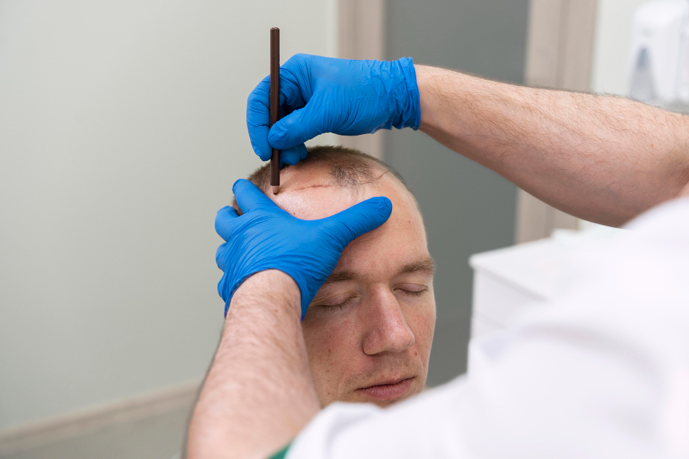 DHI Hair Transplant