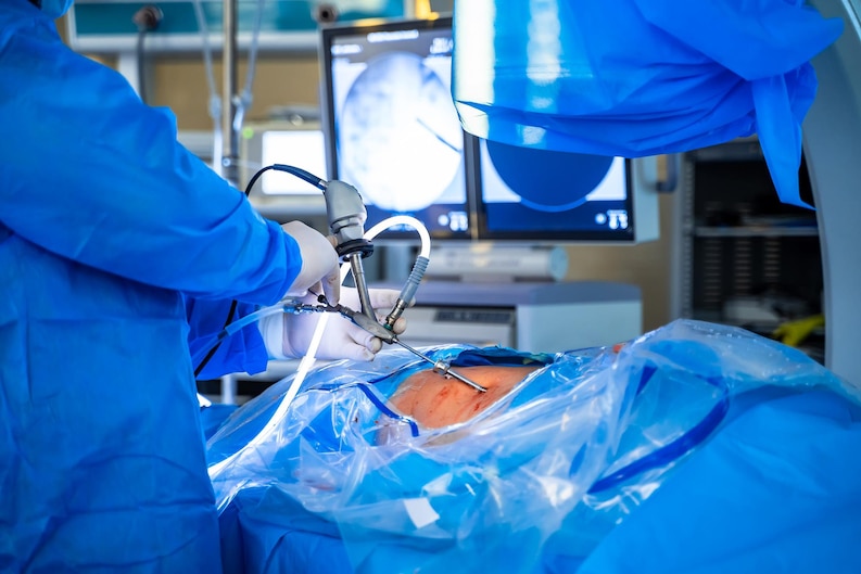 What is a laparoscopic cholecystectomy?