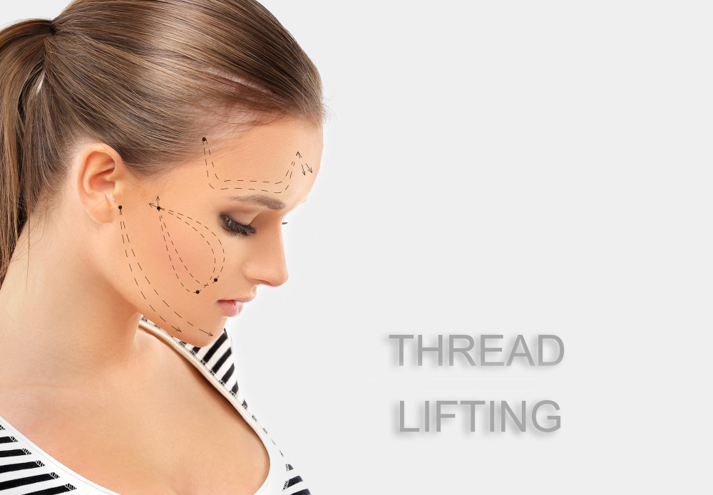 What Is A Thread Lift?