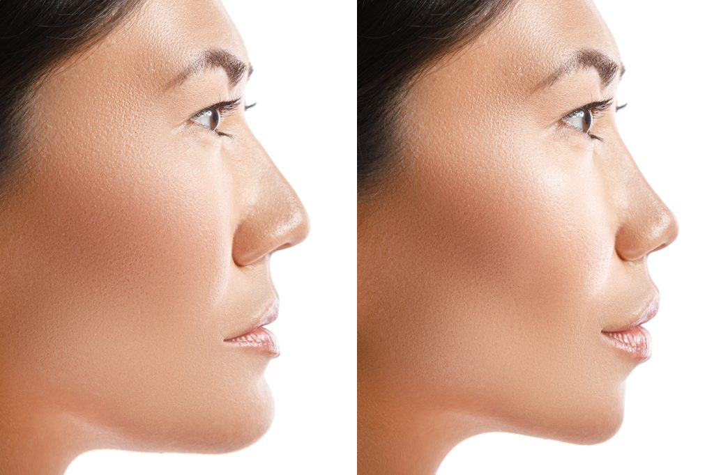 Jaw Surgery (Orthognathic Surgery)
