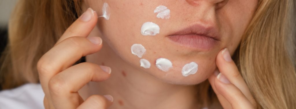 Hyperpigmentation