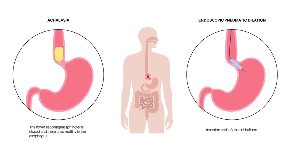 Achalasia