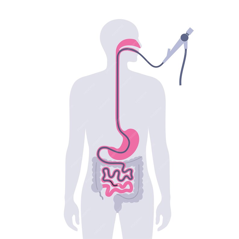 Achalasia