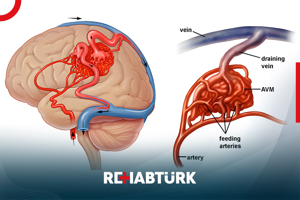 Treatment of cerebral vascular dilation in Türkiye