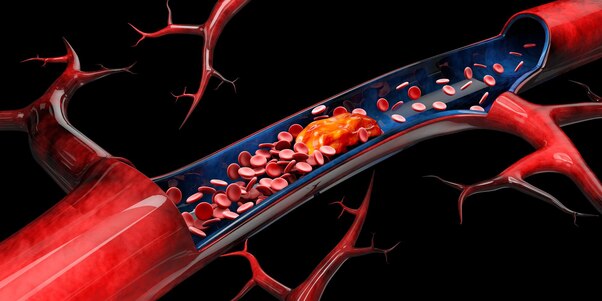 Endovascular Surgery