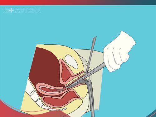 Dilation and curettage of the uterus in Türkiye