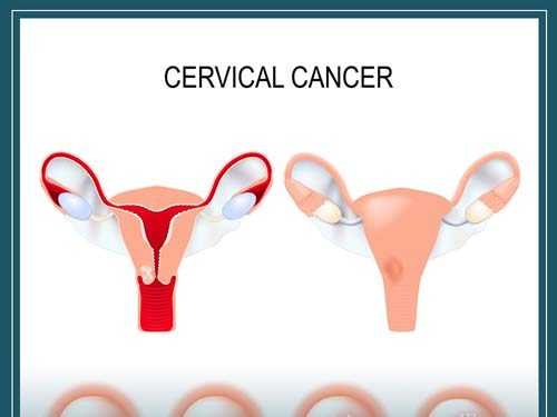 Cervical dysplasia treatment in Türkiye