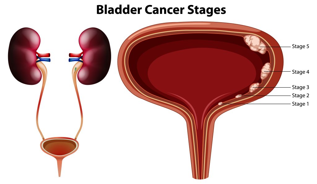 Cystoscopy: A Quick and Easy Way to Diagnose Urinary Tract Problems