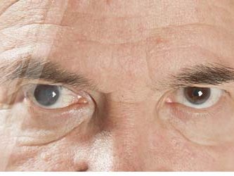 Treatment of glaucoma in the eye (glaucoma) in Türkiye