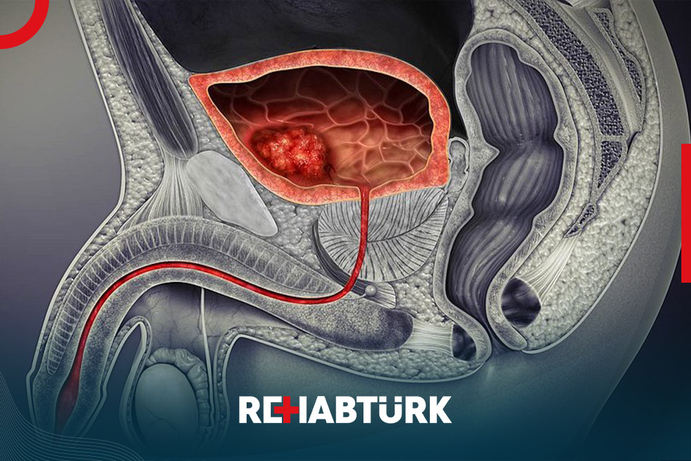 Bladder cancer treatment in Türkiye