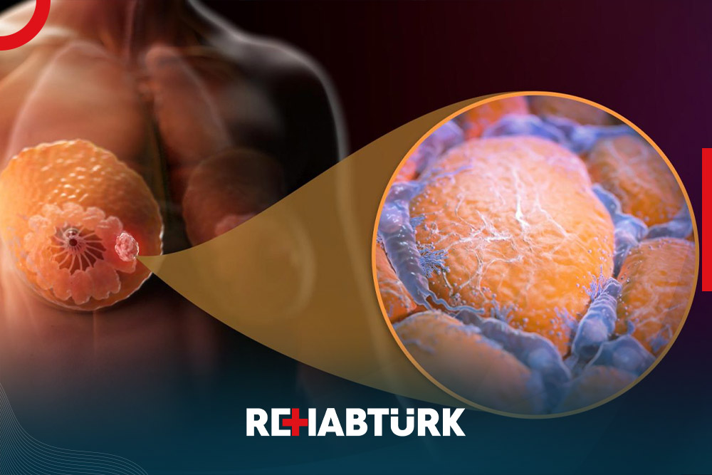 Fibroadenoma treatment in Türkiye